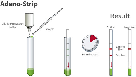 Procedure Adeno strip
