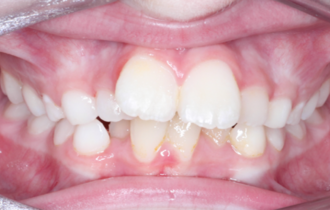 Léa, 8 ans<br>Traitement orthodontique fonctionnel