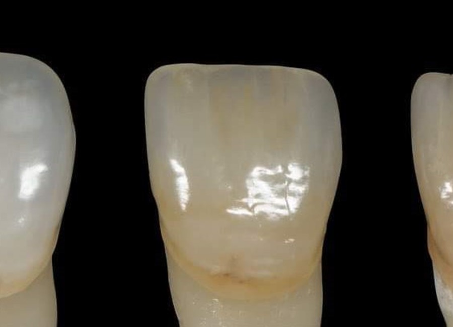 Disilicate de Lithium